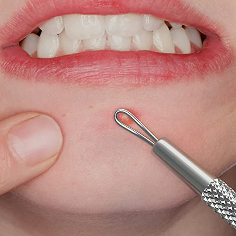 Suvorna White Head Remover for face Tool - Whitehead Extractor Tool - Nose Whitehead Remover Tool - Double Loop Whitehead Remover for face - White Head Remover for Nose