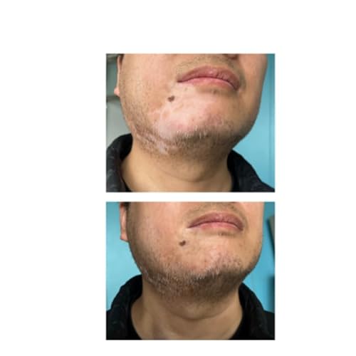 ZHEHZI Vitiligo Concealer, Waterproof Skin Concealer, Long-Lasting 3-7 Days, Face &Hands&legs& Body Coverage, full coverage and suitable for all kind of skin, 30ml (dark skin, face and body)