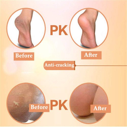 1 Pair Unisex Heel Socks Heel Sleeves Plantar Inserts Pads Heel Cushion Protectors for Achilles Tendonitis Tendon Heel (10)