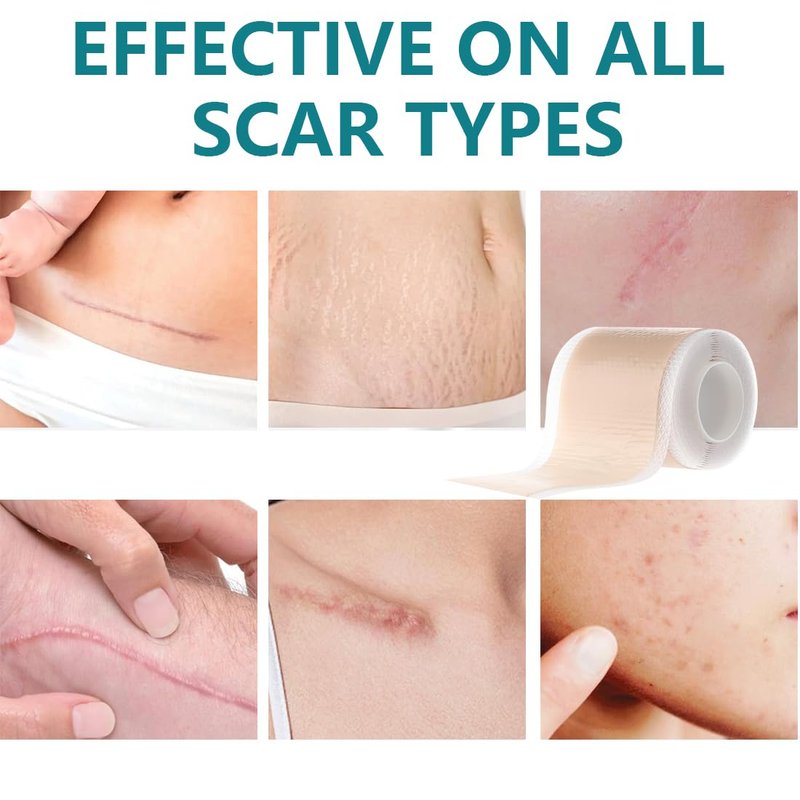Silicone Scar Sheets 1.57 x 59 inch Silicone Scar Tape Extra Long Silicone Scar Strips Wound Dressing Supplies Silicone Scar Sheeting Silicone Scar Patches for C-Section Tummy Tuck Keloid