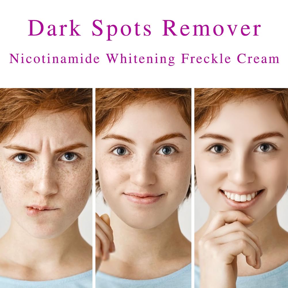 Dark Spot Remover for Face,Nicotinamide Whitening Anti-Freckle Cream,Skin Dullness Lightening Body Cream,Visible Results in 28 Days,Smooth Melasma,Hyperpigmentation Age Dark Spot Corrector,0.7 oz