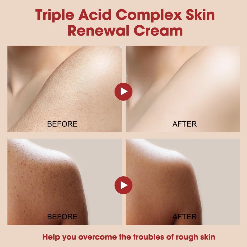 Xaninp Skin Treatment Resurfacing Cream for Keratosis Pilaris, Advanced Triple-Acid AHA BHA PHA Exfoliator Lotion — Smooths Chicken Skin Bumps, Hydrating, Brightening & Soothing