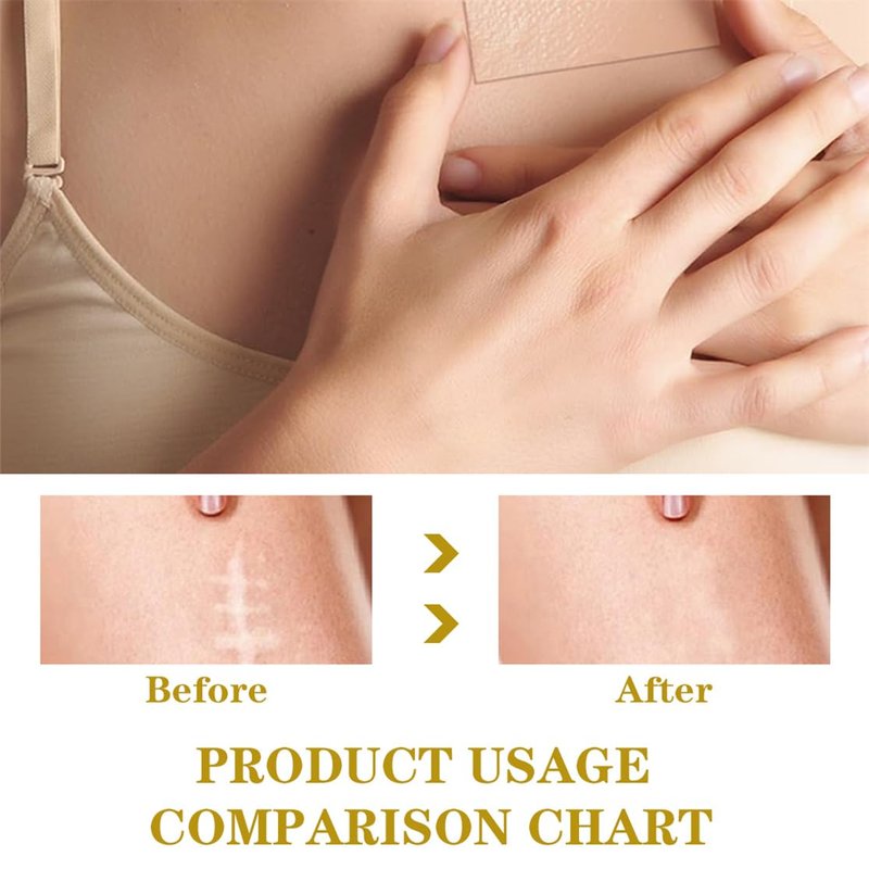 Silicone Scar Sheets, Scar Tape for Surgical 2inch X 118inch Silicone Skin Patches for C-Section Keloid Bump and Acne Scars Removal Treatment