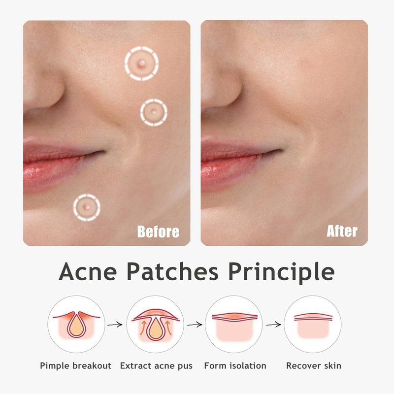 Dazzlook Ultra Pimple Patches, Zits and Blemishes Patch with Salicylic Acid (96 Counts), Invisible Hydrocolloid Pimple Stickers Large Bulk for Face and Skin