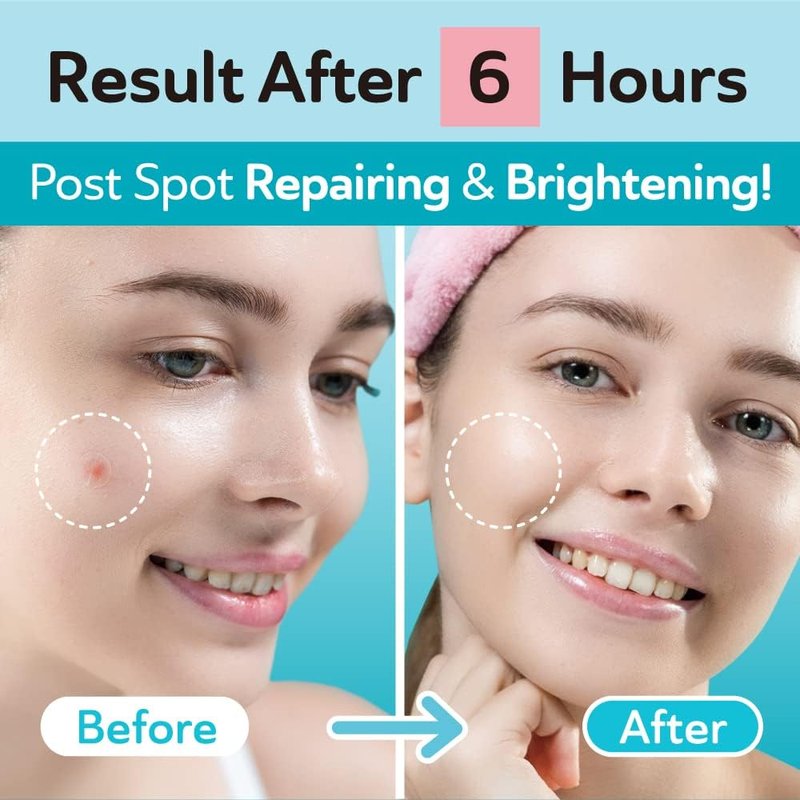 DERMA ANGEL Ultra Invisible Acne Patches for Cystic Acne Treatment Pimple Patches for Cystic Acne Blemish Patches Hydrocolloid Patches - Day & Night Use - UPGRADED (Acne Specialist 120 Count 2 Sizes)