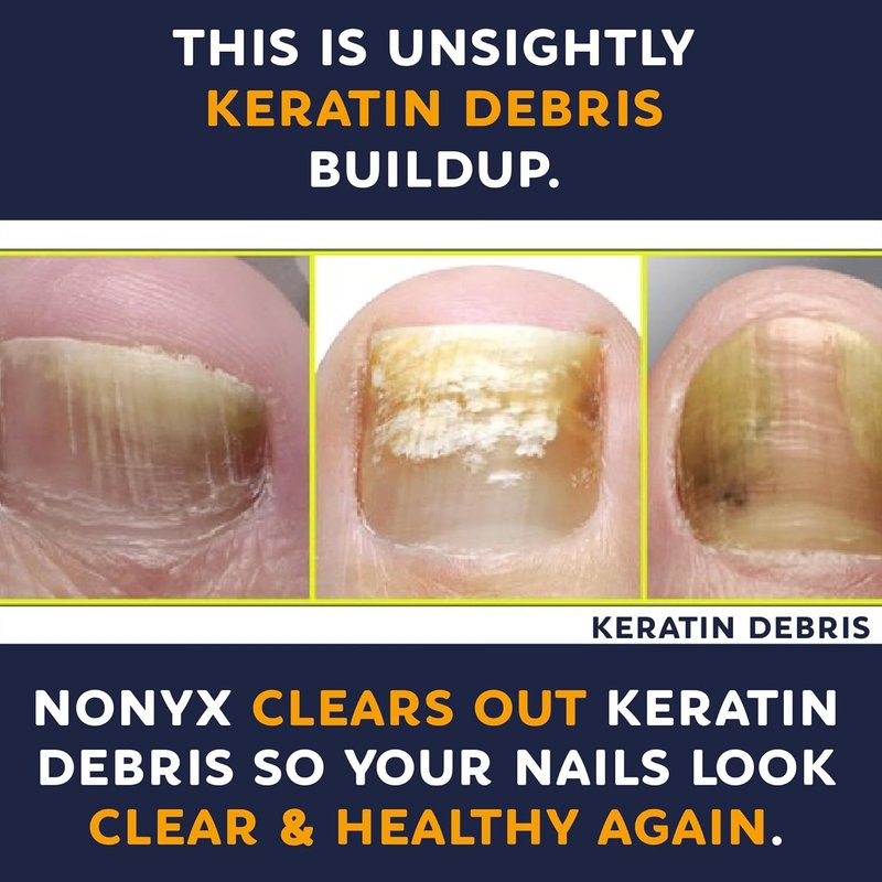 NONYX Fungal Nail Clarifying Gel - Clinically Proven Treatment for Discolored, Thick, and Brittle Toenails | 90% Improvement Rate