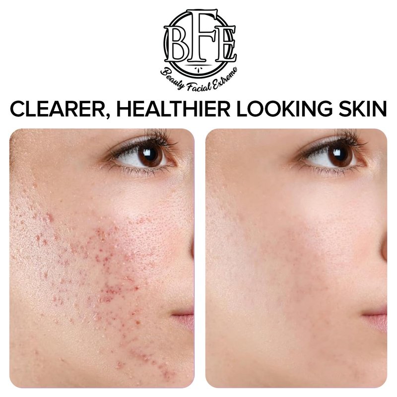 Acne Treatment Pads- Eliminates Cystic Breakouts, Oily Skin & Clogged Pores. Clear Pimple, Whitehead, Blackhead, Dark Spots & Improve Skin Texture.