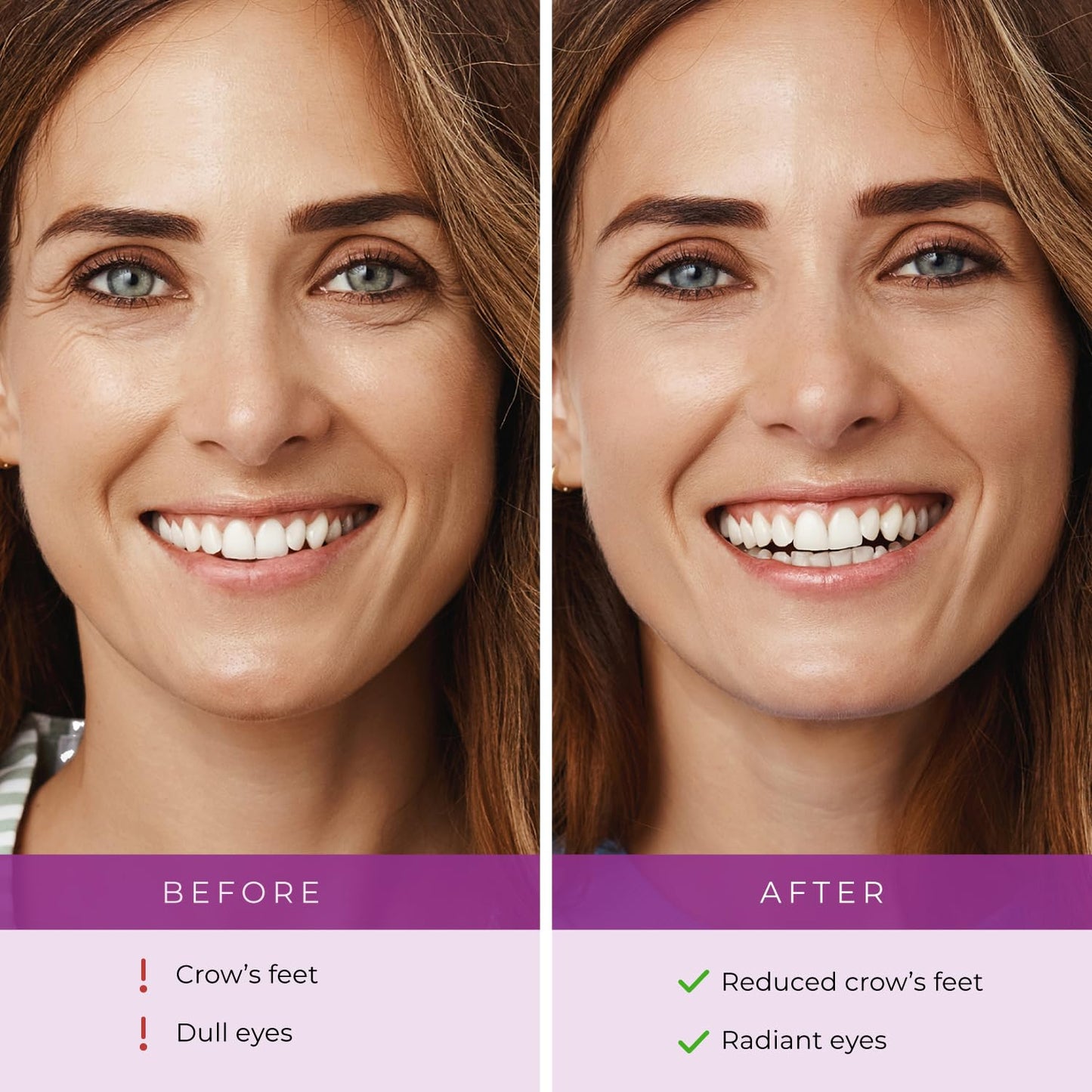 Furlesse Relax Fine Lines Elevens Wrinkle Patches (30 day supply) for Frown Lines – Anti-Aging Patches 1