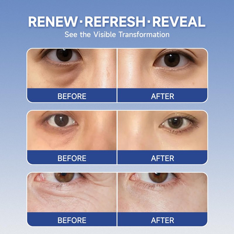 8 pairs PDRN &Calcium Micro Eye Patches, Under Eye Patches for Puffy eyes, Dark Circles & Wrinkle | Hyaluronic Acid, Kojic Acid, Collagen, Peptides, Vitamin C, Niacinamide - Korean Popular Eye Care