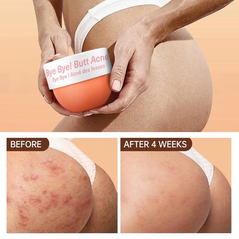 LA.PERSONAL Butt Acne Clearing Cream, Body Acne Treatment with 2% Salicylic Acid & Tea Tree Oil, Acne Cream for Buttocks Body Back, Moisturize Cream 5.46 oz