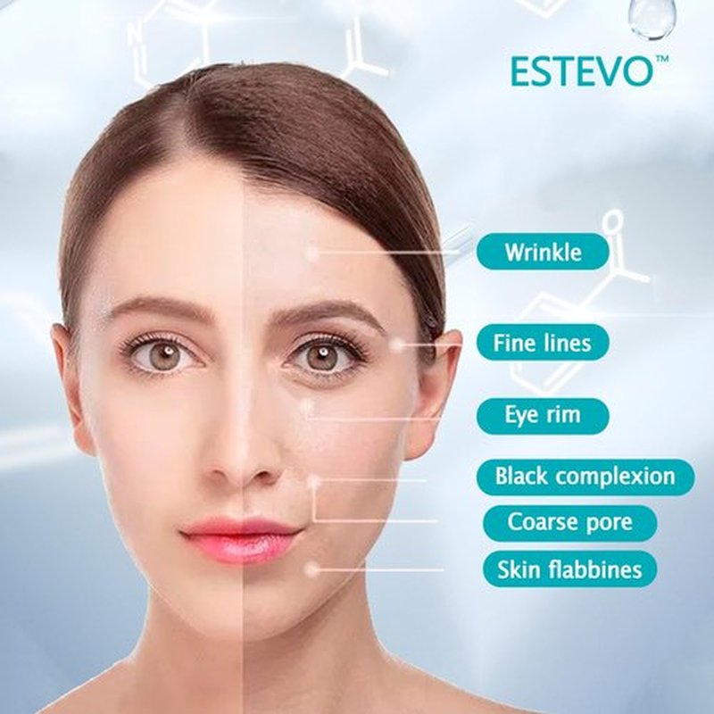 ESTEVO PDO Screw Thread, Improves Skin, Lift and Restore Skin Elasticity and Radiance, Pdo Thread Increase Firmness (20PCS-26G*60mm)
