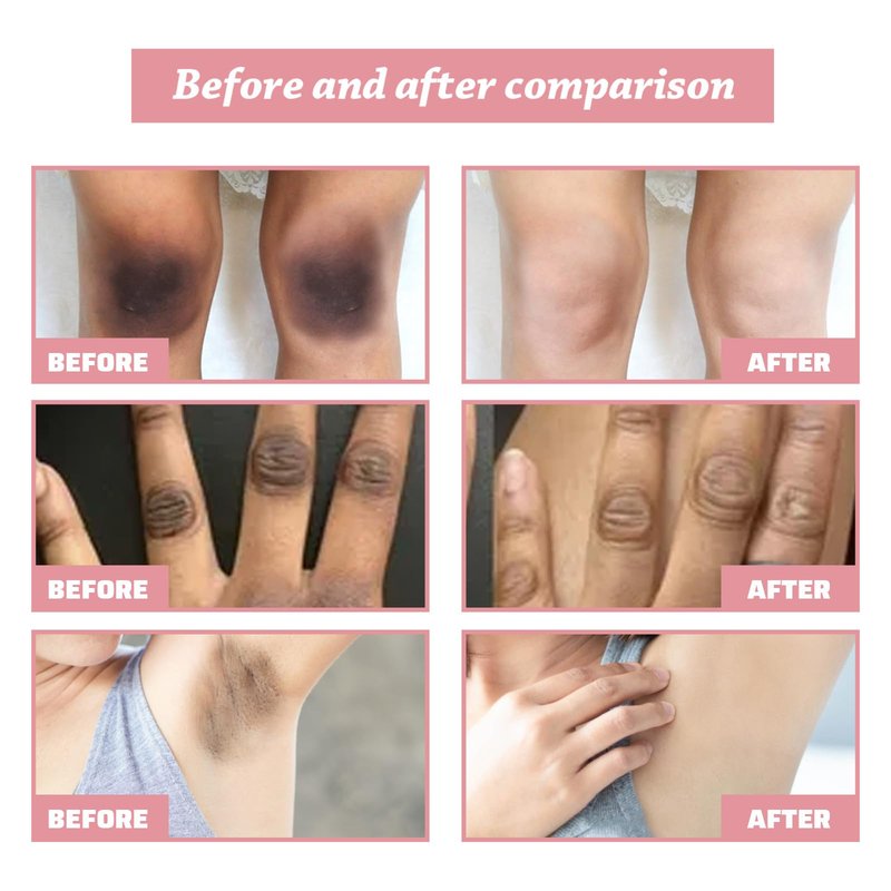 BEROZA Crema Reparadora Para Manchas Oscuras 50ml, Crema íntima para mujeres, Adecuado para varias áreas como cara, axilas, cuello, zona privada