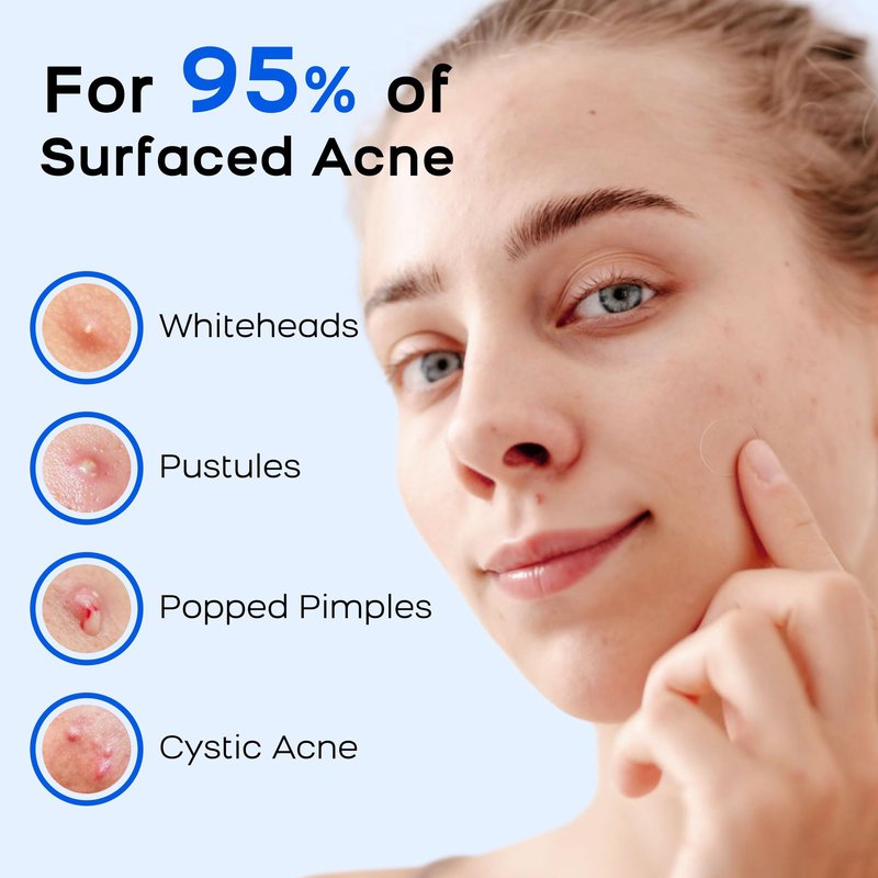 AVAPY Pimple Patches For Face, Invisible Hydrocolloid Acne Patches-Zits & Blemish, Covering Zits & Blemishes in Face and Skin, Control Oil, Pimple Patch with Salicylic Acid (84 Count)