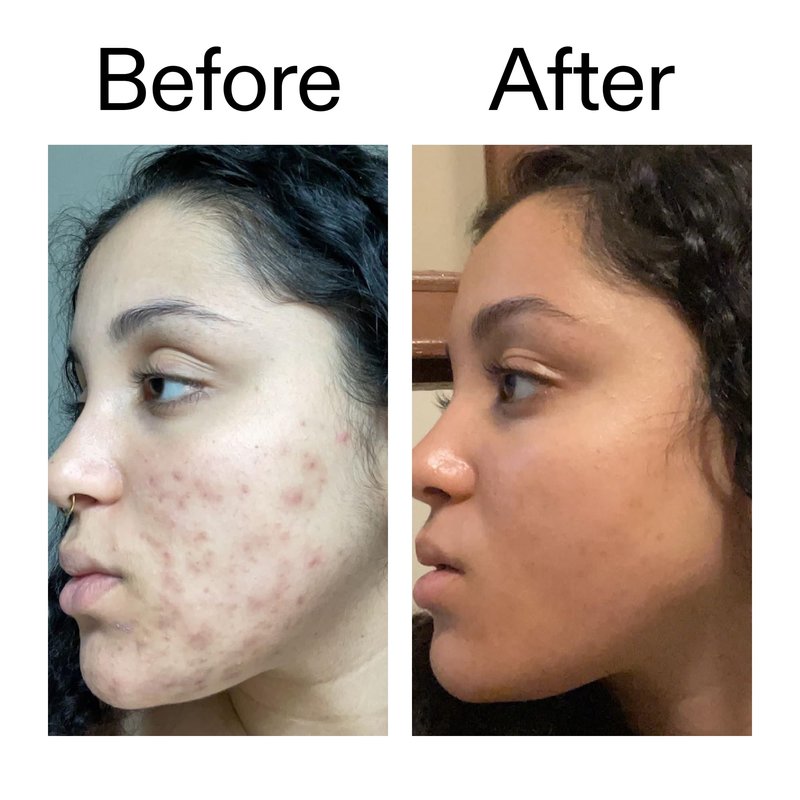 The INKEY List Tranexamic Acid Serum, Helps Reduce Appearance of Skin Discoloration, Dark Spots and Uneven Patches, Healthy-Looking Skin Tone, 1 fl oz