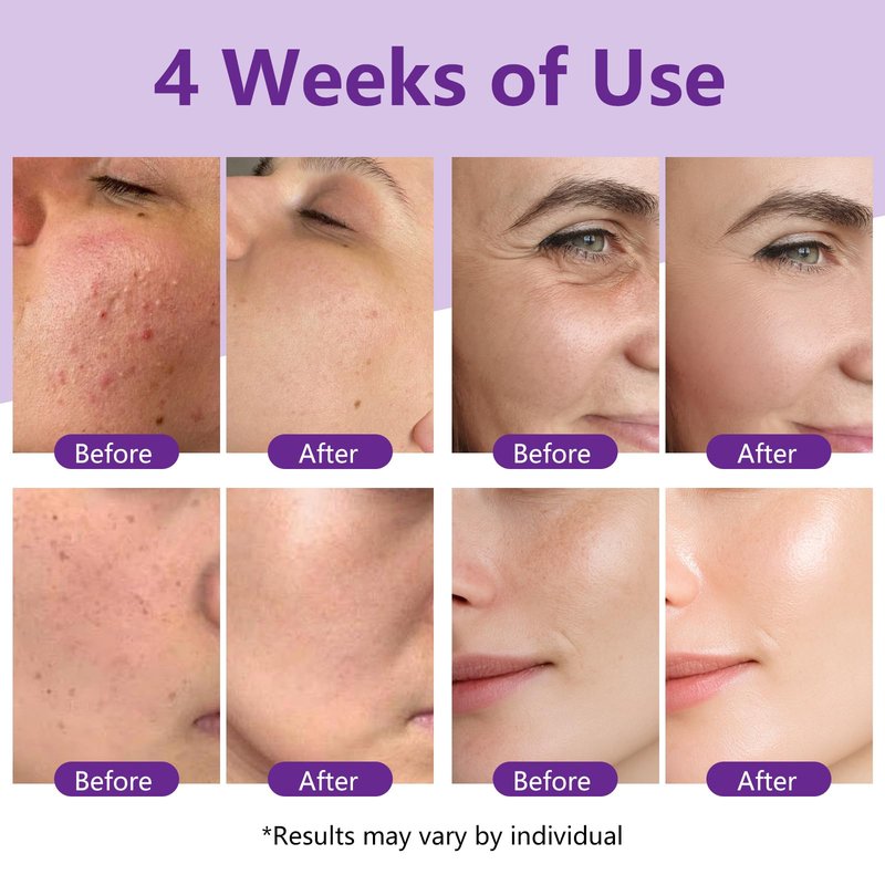 MegustaMe Resurfacing Retinol Serum for Acne Scars & Pores, 30ml. Encapsulated Retinol for Sensitive Skin, Gentle Anti-Aging with Less Irritation. Dermatologist-Developed.