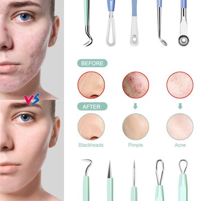 Pimple Extractor Pimple Popper Tool Kit, MENOLY 10Pcs Blackhead Remover Tools, Acne Tools, Acne Kit for Blackhead,Blemish,Zit Removing, Whitehead Popping and Comedone Extractor Tool with Leather Bag