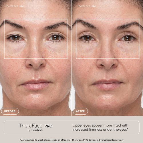 TheraFace PRO Microcurrent Facial Device - 8-in-1 Compact Face Massager, Facial Kit & Face Sculpting Tool with Light Therapy for Skin Tightening, Anti Wrinkle, Anti Aging & Skin Care (White)