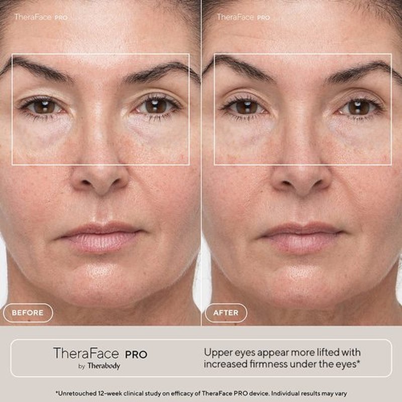 TheraFace PRO Microcurrent Facial Device - 8-in-1 Compact Face Massager, Facial Kit & Face Sculpting Tool with Light Therapy for Skin Tightening, Anti Wrinkle, Anti Aging & Skin Care (White)