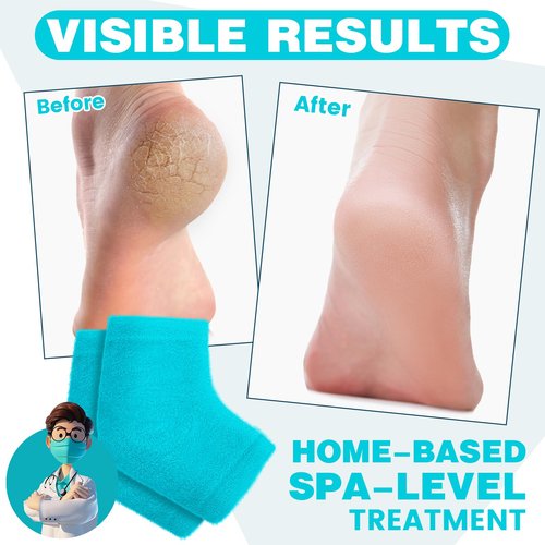 TEAWOO 3 Pairs Fuzzy Moisturizing Heel Socks for Cracked Heel Treatment, Toeless Socks for Women & Men, Cracked Heel Repair, Hydrate Dry Cracked Feet Heels (Blue)