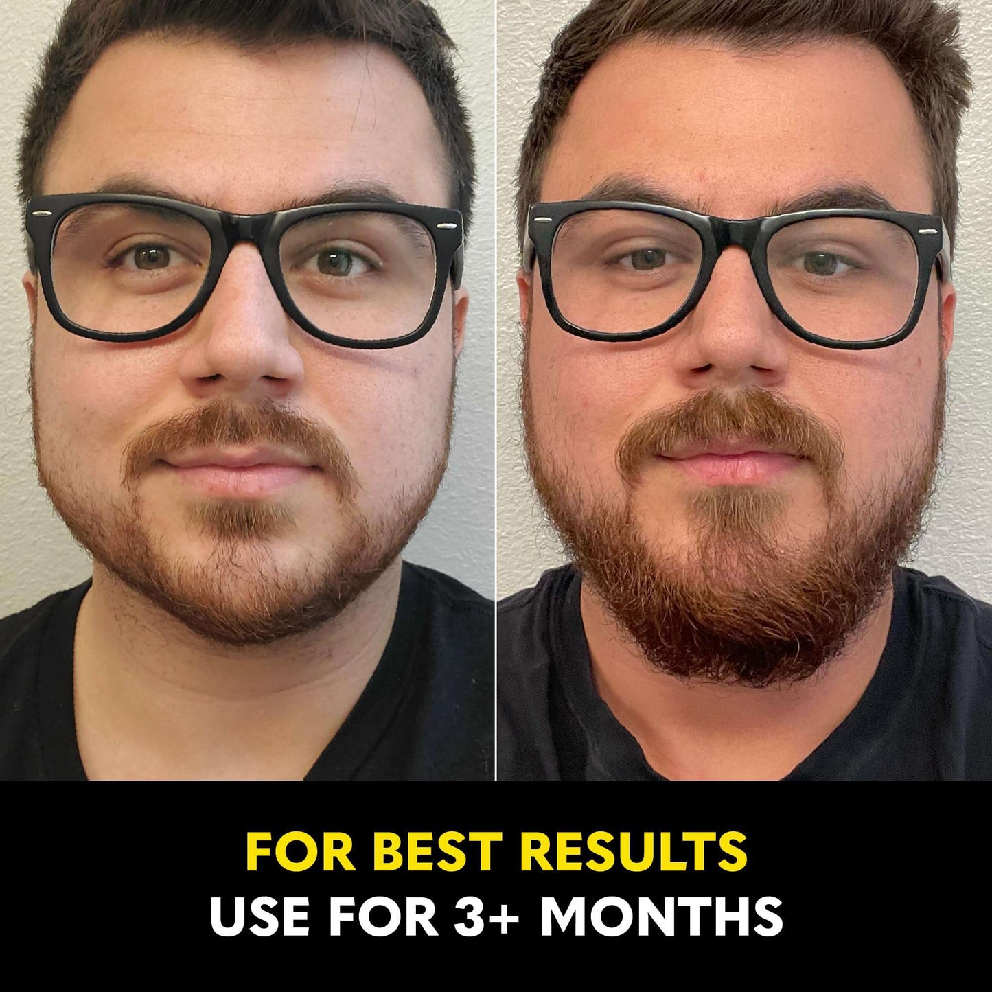 Beard Club - Beard Growth Serum with Natural Castor, Coconut and Avocado to Grow a Thicker, Fuller Beard, Fill in Patches and Stimulate Healthier Facial Hair Growth