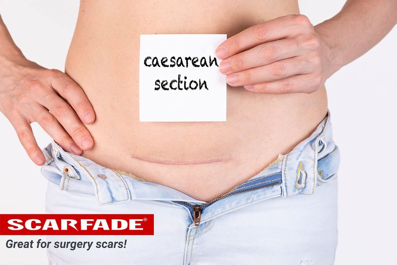 ScarFade Elite Advanced Scar Treatment, Scar Removal, Scar Therapy, Scar Prevention, Anti Scar Gel with Silicone & Vitamin C -15g