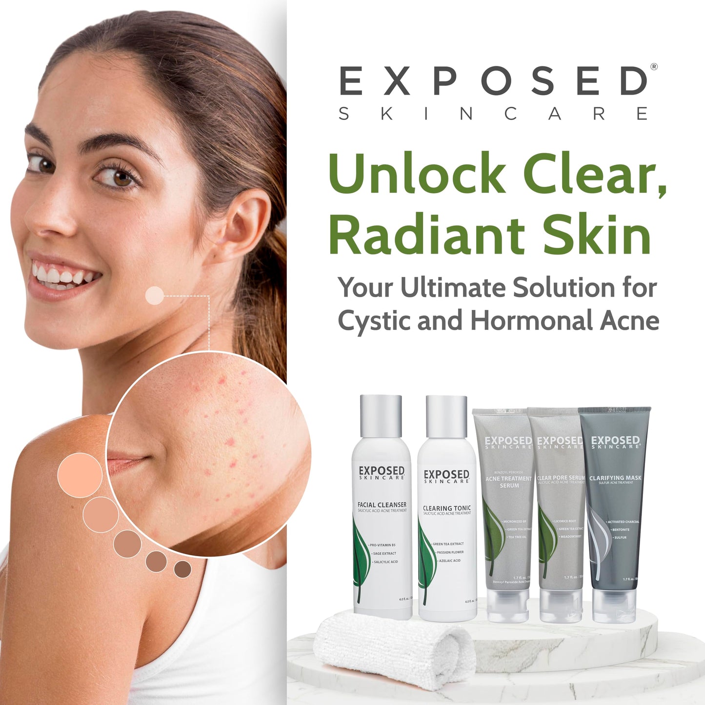Exposed Skin Care, Acne Treatment Kit with 2.5% Salicylic Acid and 3.5% Benzoyl Peroxide to Clear Up Teen, Adult, Hormonal and Cystic Acne – Natural, Non-toxic and Cruelty Free