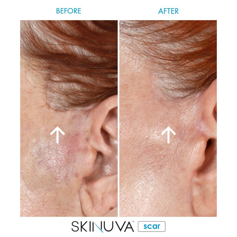 Skinuva® Scar Cream for Face & Body (1.5 oz)