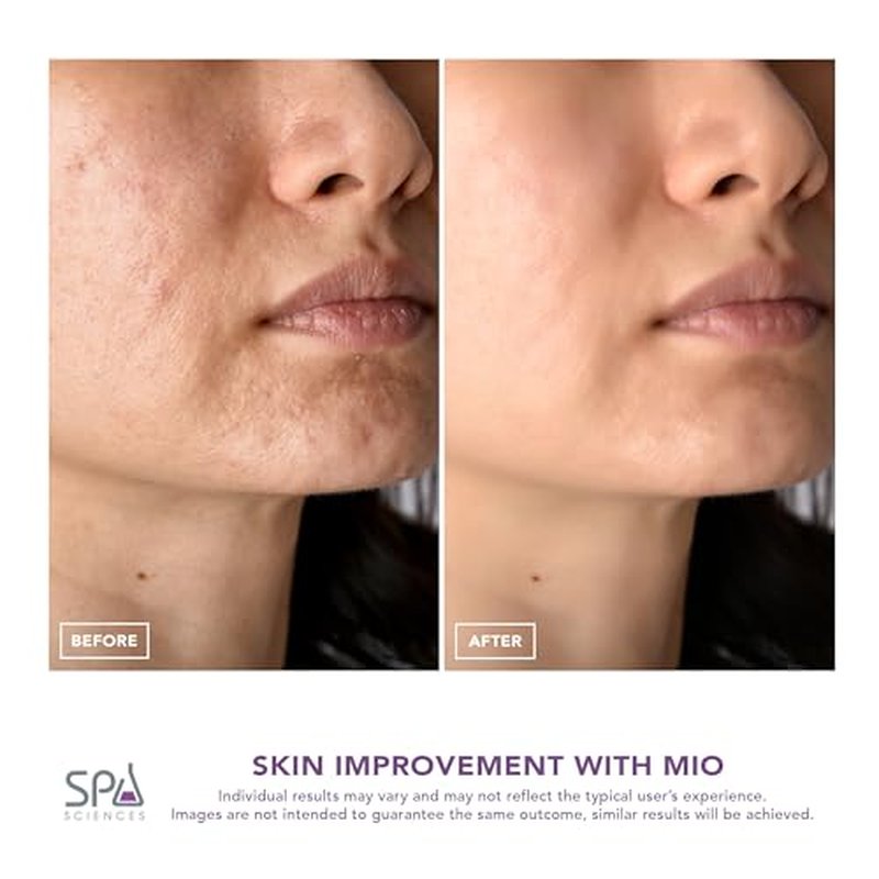 Spa Sciences - MIO - Diamond Tip Microdermabrasion Blackhead Remover, Pore Cleansing, & Resurfacing System - Reduces Acne Scars, Wrinkles, and Exfoliates for Clearer Skin