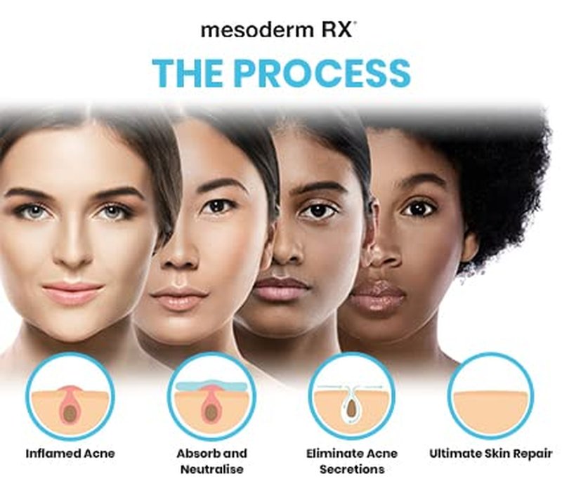 Hydrocolloid Acne Patch - Mesoderm RX Pimple Treatment Stickers for Face & Skin | 72 Count