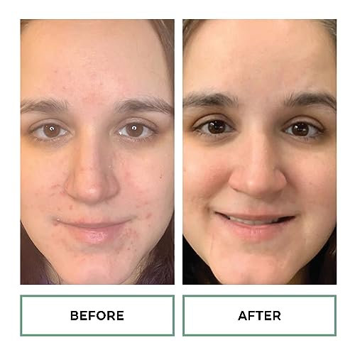 Replenix 10% Benzoyl Peroxide Wash, Advanced Acne Cleanser for Face and Body, 6.7 oz.