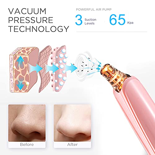 Blackhead Remover Pore Vacuum Cleaner - Upgraded Facial Pore Cleaner - Electric USB Pore Vacuum with 5 Probes - Upgraded Blackhead Suction Tool - Blackhead Remover Kit (Pink)