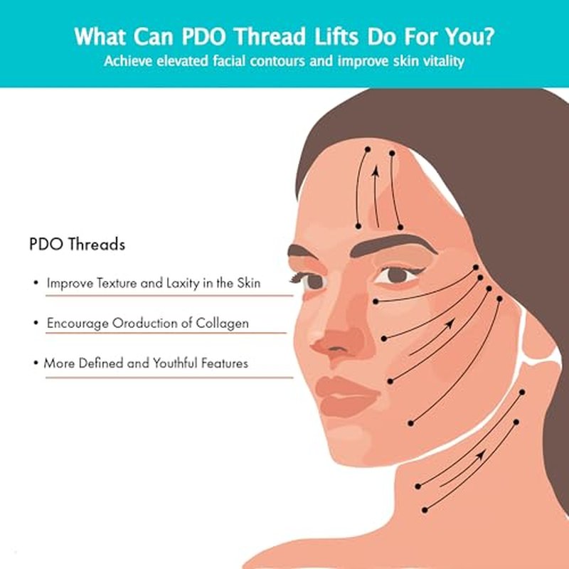 ESTEVO PDO Screw Thread, Lift Face Tip Screw Threads, PDO Threads Face Lifting Face & Whole Body (100PCS-26G*50mm)