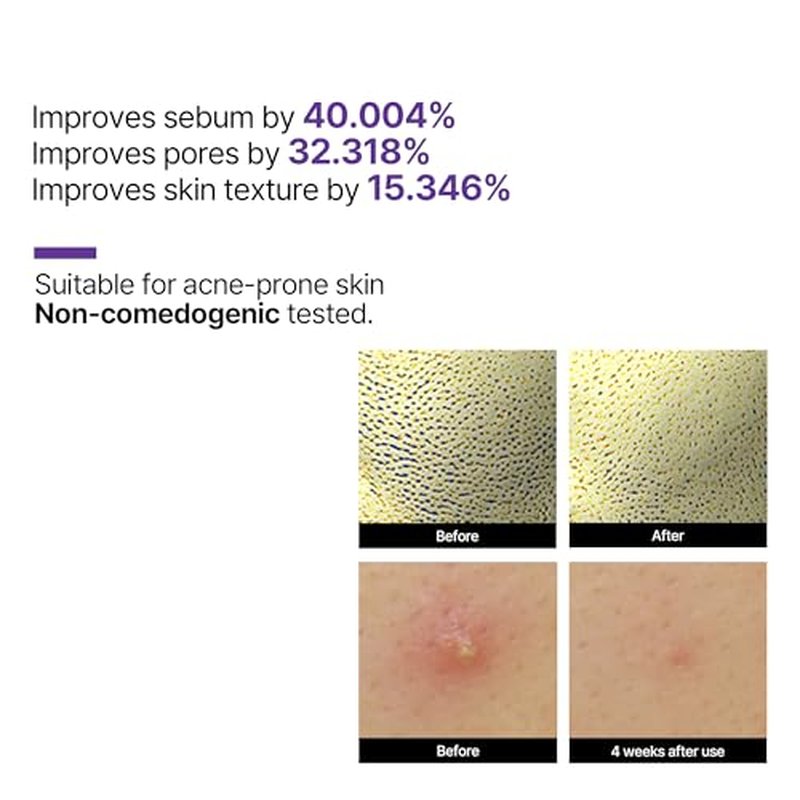 SOME BY MI Retinol Intense Reactivating Serum - 1.01Oz, 30ml - Mild Korean Retinol Serum for Post-Acne Mark - Bakuchiol Pore Minimizer for face Texture - Ideal for Retinol Beginners - Korean Skin Care