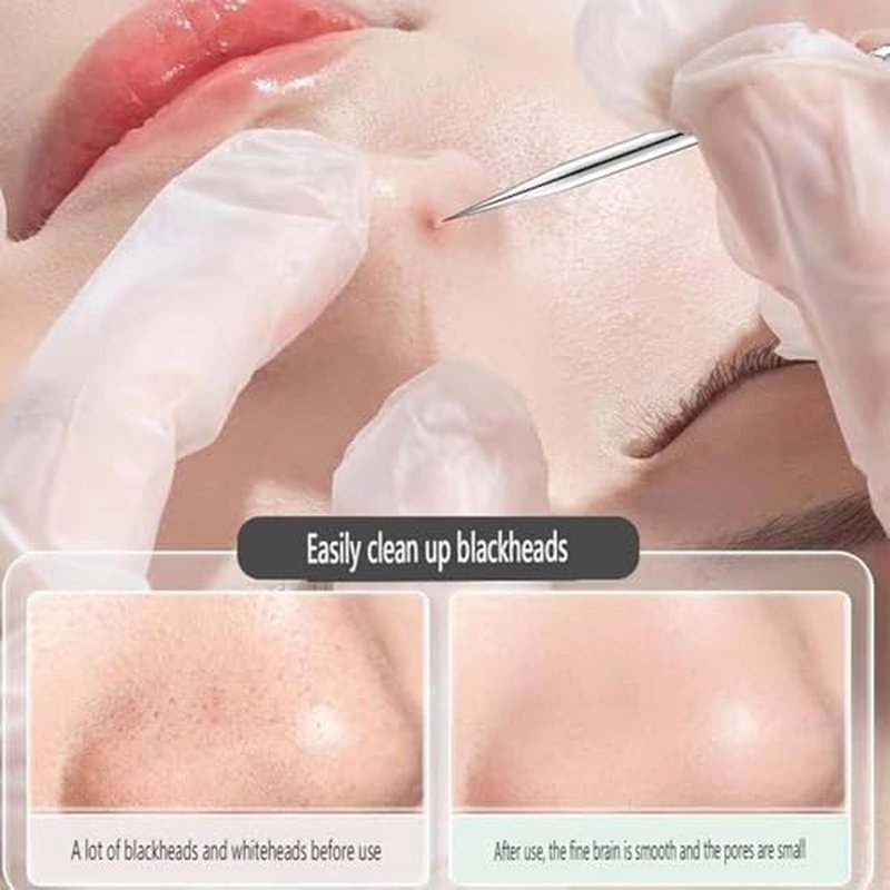 Usiveinborn Blackhead Remover, Usiveinborn Tweezers, Self Clip 0.05 Mm Tweezers, Professional Facial Blackhead Remover Tweezers, Blackhead Remover Tweezers (A)