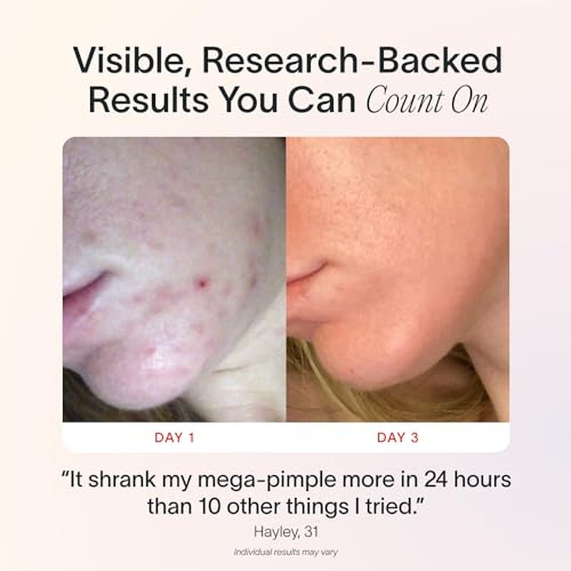 Solawave Bye Acne Spot Treatment, Red Light Therapy and Blue Light Therapy, Use Before Pimple Patches. Acne Light Device, Face Care Must-Have, Charcoal
