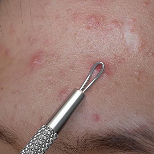 Suvorna White Head Remover for face Tool - Whitehead Extractor Tool - Nose Whitehead Remover Tool - Double Loop Whitehead Remover for face - White Head Remover for Nose