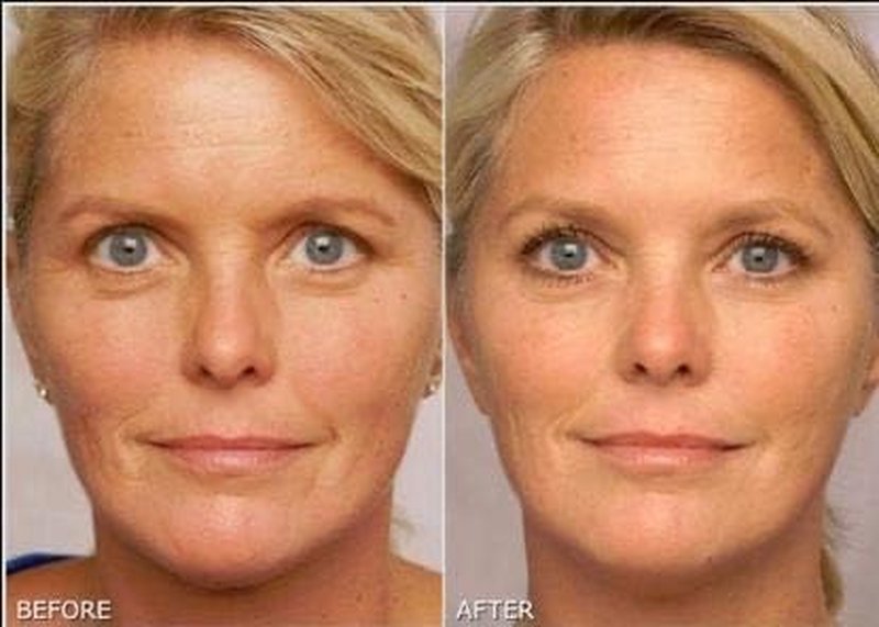 Retinol Gel 0.1% - Anti-Aging Treatment for Fine Lines, Wrinkles & Scars | 20 Grams