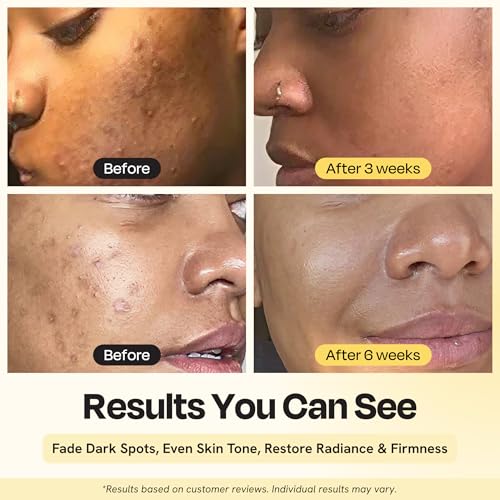 Gleamin Superactive Vitamin C Serum for Face with 15% Vitamin C, Niacinamide, Bakuchiol & Hyaluronic Acid ? Skin Brightening Facial Serum for Women & Men ? Dark Spot Remover & Radiant Glow ? 1 fl oz