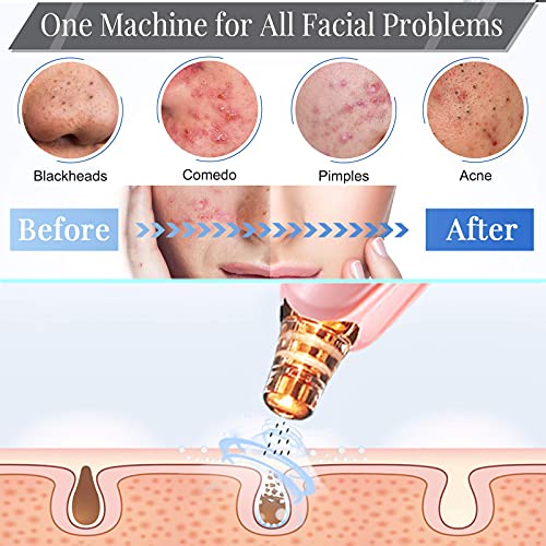 Blackhead Remover Pore Vacuum Cleaner - Upgraded Facial Pore Cleaner - Electric USB Pore Vacuum with 5 Probes - Upgraded Blackhead Suction Tool - Blackhead Remover Kit (Pink)