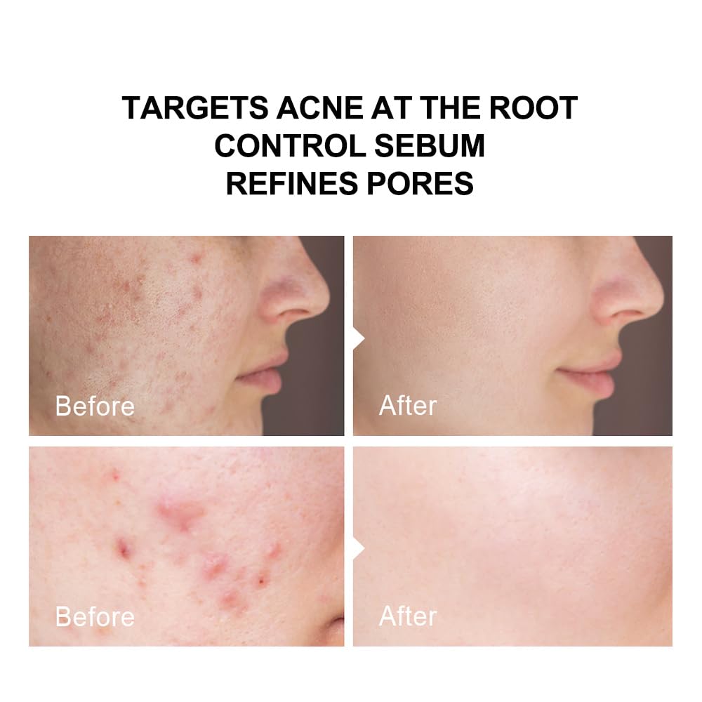 pure.tiful 2% Salicylic Acid (BHA) Serum for Acne & Blackheads - Unclogs Pores, Oil Control, Sensitive-Skin Safe, Fragrance-Free,1 fl.oz