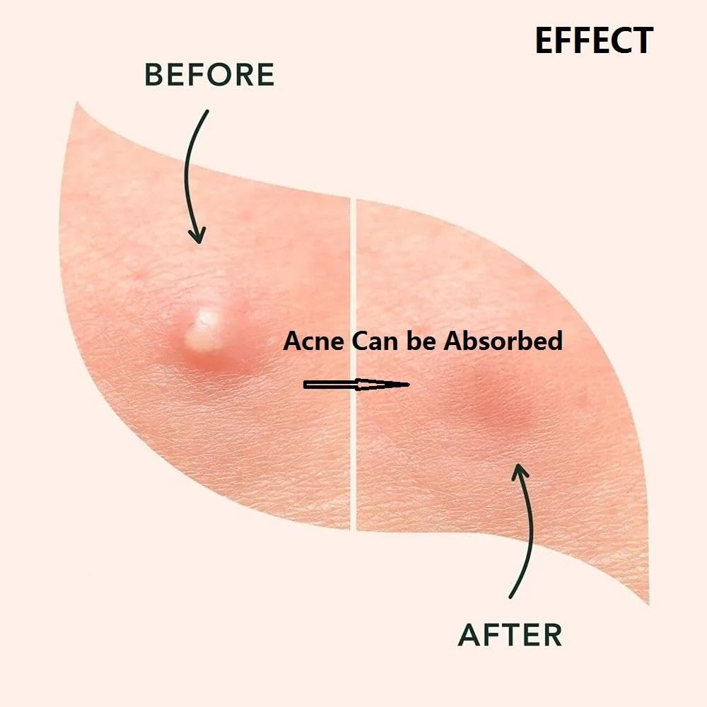 ESSENTYA COSMETICS Pimple Patches For Acne (72 units), Invisible Hydrocolloid Patches For Day and Night. Ultra Thin, Non-Irritating and Fast Healing