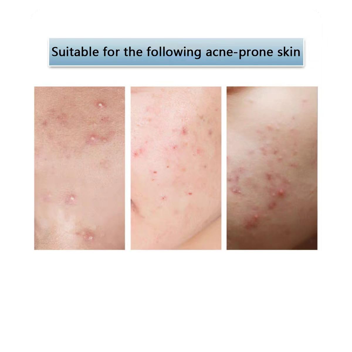 Pimple Patches for Face, 153 pcs Acne Patches, Cute Zit Covers for Face, Spot Stickers with Tea essential oil ， Salicylic Acid and Cica Oil