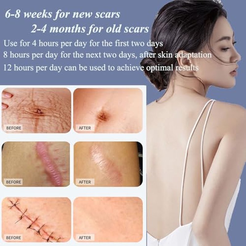 Medical Grade Silicone Scar Sheets 1.6"x 118" Roll-3M Keloid Scars Removal C-Section Scar Strip Painless Treatment Resuable Tummy Tuck Tape Professional for Surgical Incision,Acne,Burn Scar