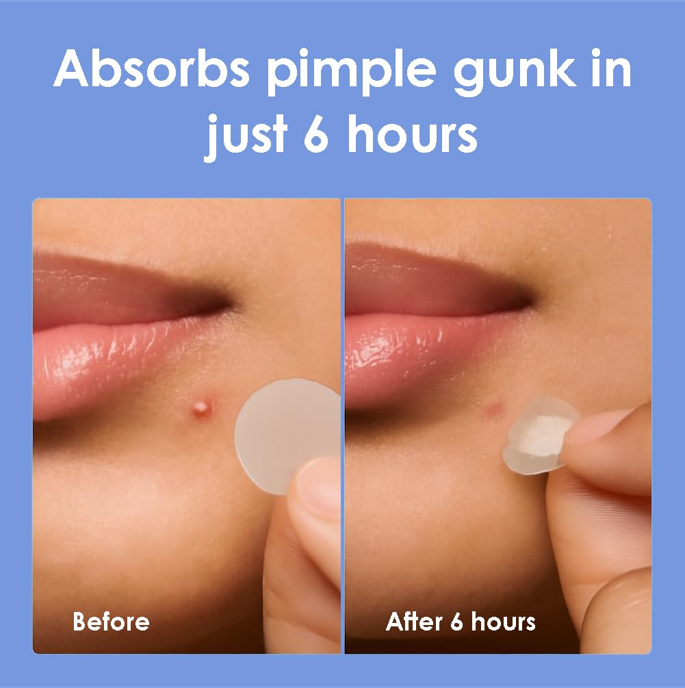 Pimple Patches for Face (1250 Count), Cut-to-Size Hydrocolloid Roll Tape - Pimple Patch Pimple Stickers - Absorb Gunk & Fast Healing - Acne Pimple Patches for Face - Zit Patches - For All Size Acne