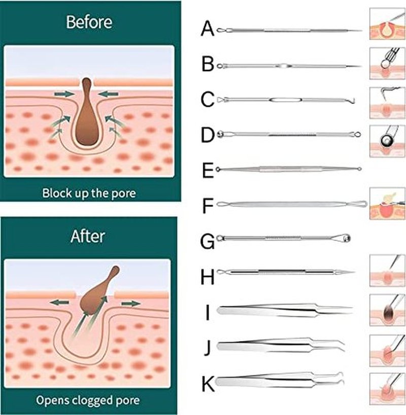 Usiveinborn Blackhead Remover, Usiveinborn Tweezers, Professional Facial Blackhead Remover Tweezers, Blackhead Remover Comedone Extractor (1 Set(All 3 Tweezers+Boxed))