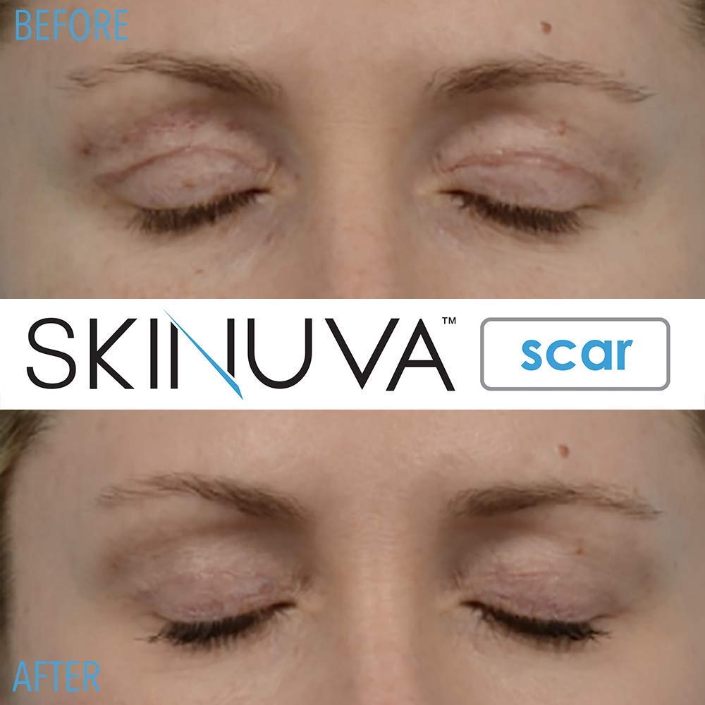 Skinuva® Scar Cream for Face & Body (1.5 oz)