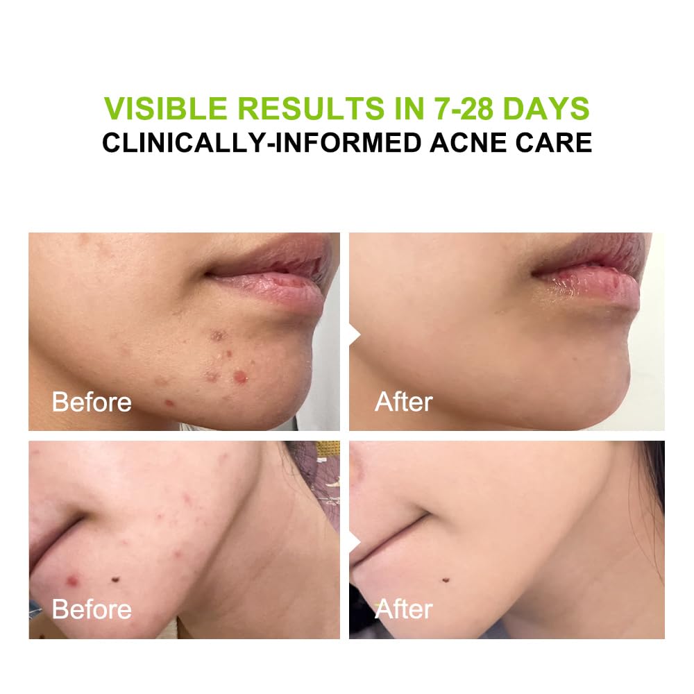 pure.tiful 2% Salicylic Acid (BHA) Serum for Acne & Blackheads - Unclogs Pores, Oil Control, Sensitive-Skin Safe, Fragrance-Free,1 fl.oz