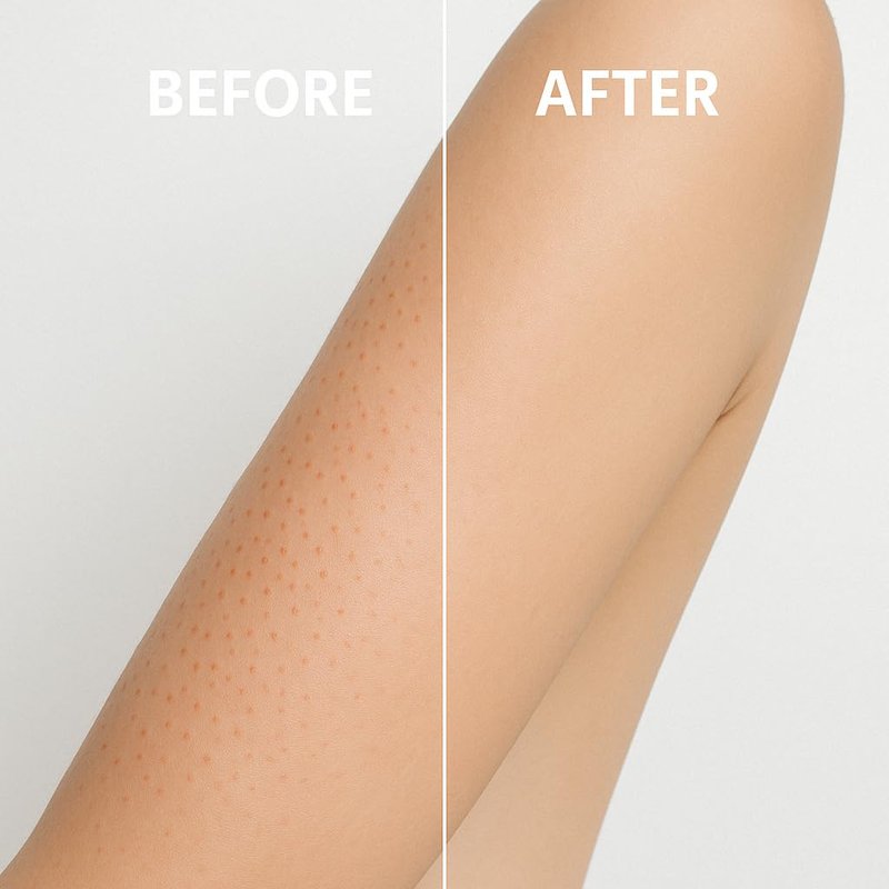 Microdermabrasion Exfoliating Scrub - KP Bump Eraser for Keratosis Pilaris & Acne | Deep Cleansing for Smooth Skin