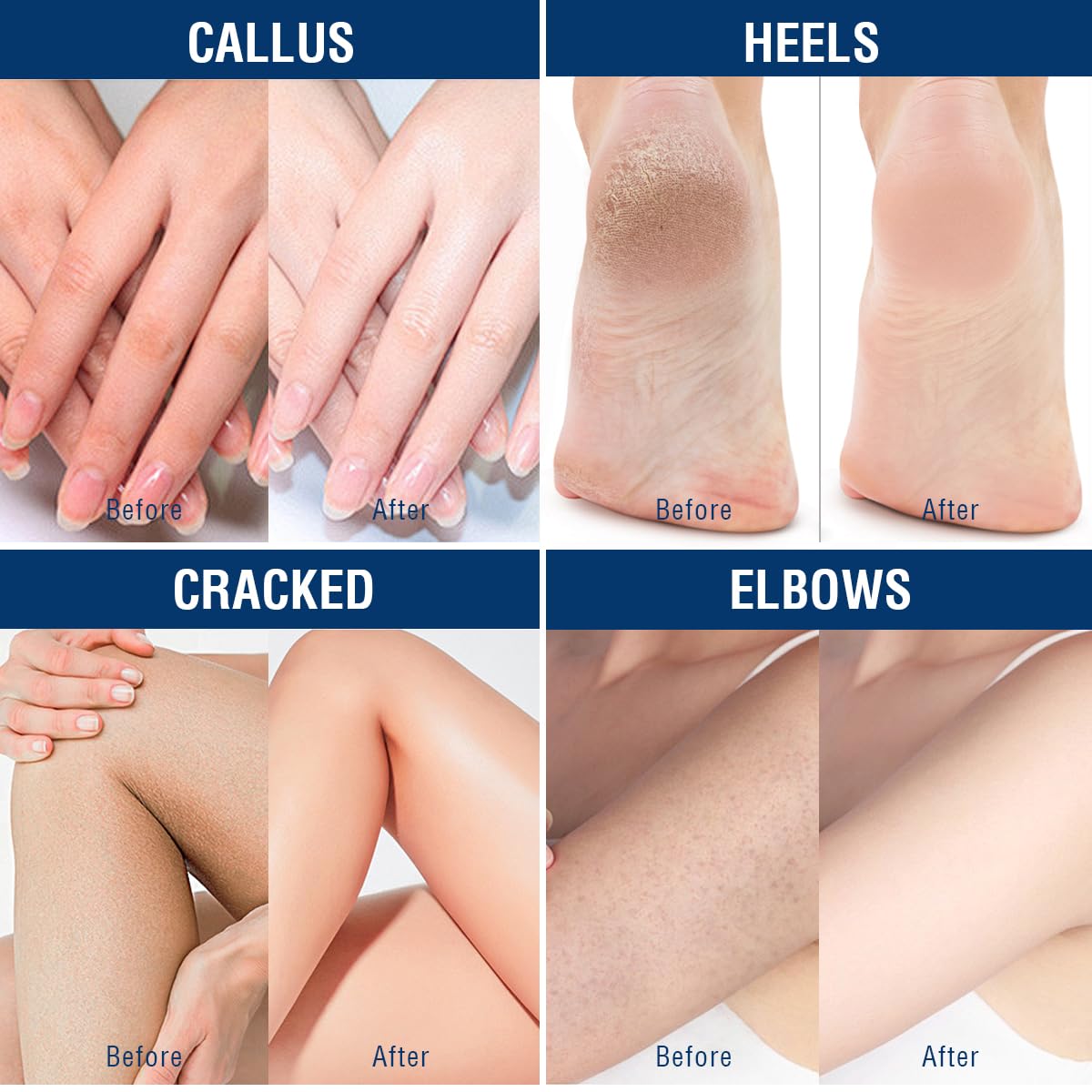 OUKEYA Urea Cream 40 Percent, Foot & Hand Cream for Dry Cracked, Urea Lotion for Feet Maximum Strength