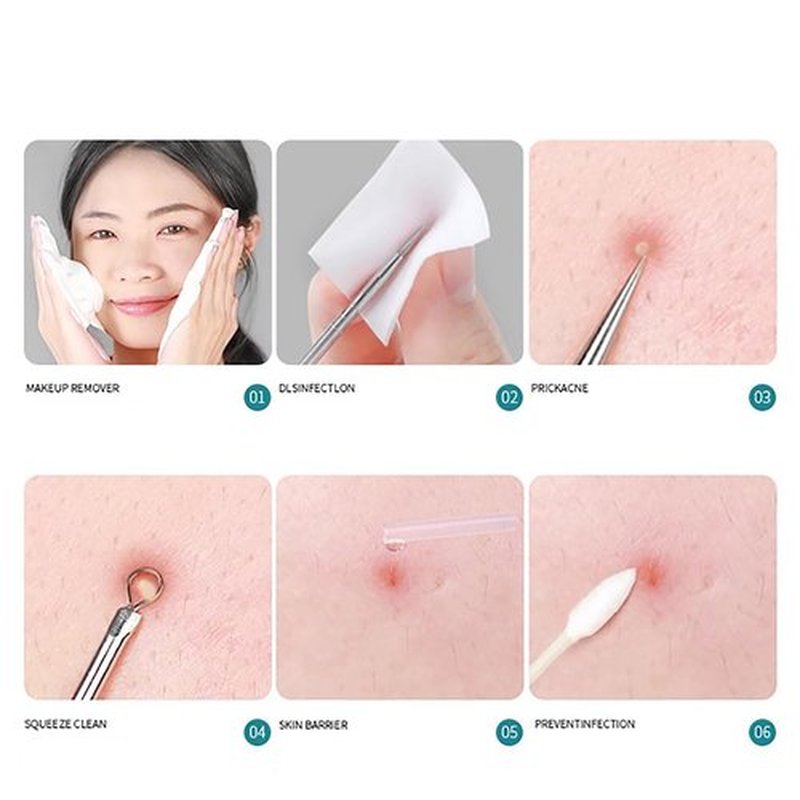 Usiveinborn Blackhead Remover, Usiveinborn Tweezers, Blackhead Tweezers, Professional Facial Blackhead Remover Tweezers, Stainless Steel Precision Pimple Popper Tool Kit (Set B)